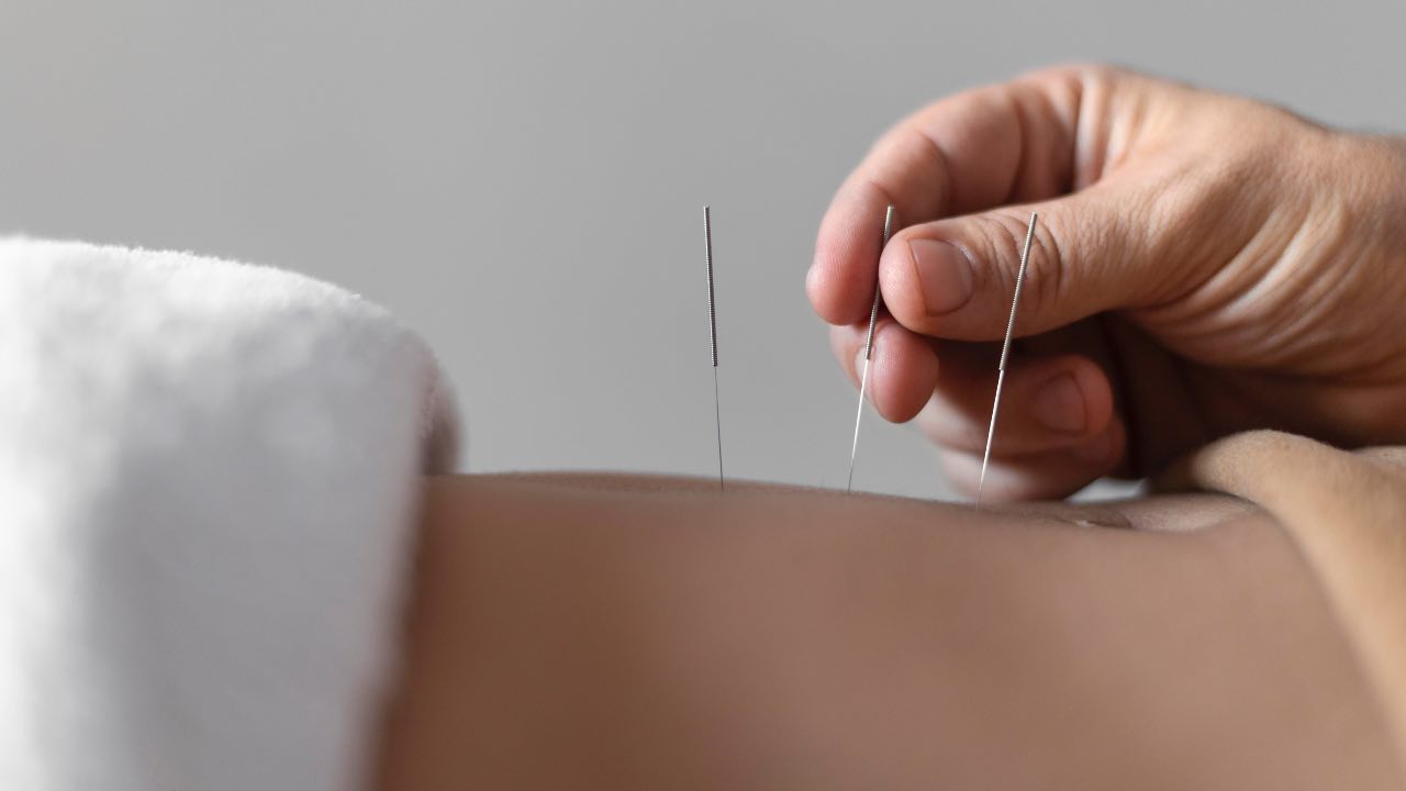 Agopuntura